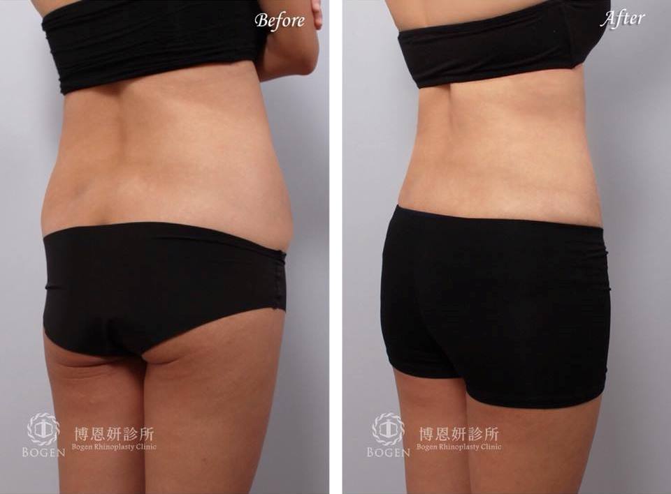 腹部抽脂,瘦小腹,博恩妍